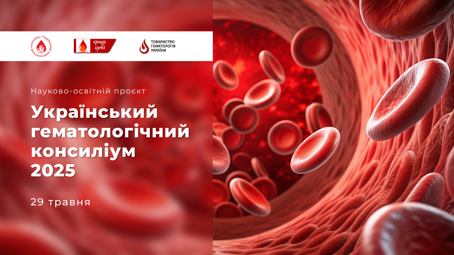 Український гематологічний консиліум 2025. Гостра лімфобластна лейкемія